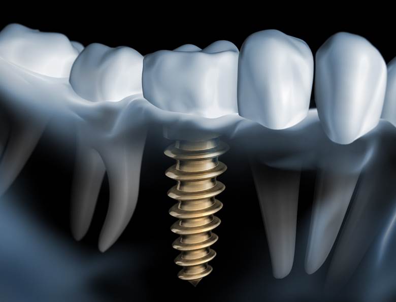 dental implant in a patient’s lower jaw