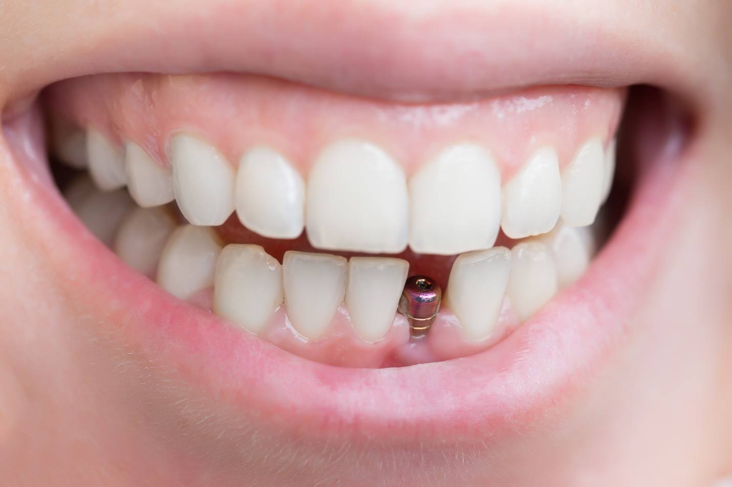 dental implant abutment in a person’s smile