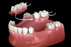 partial denture