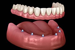 full denture on six dental implants