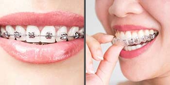 Teeth Aligners vs. Clear Braces: What's the Difference?