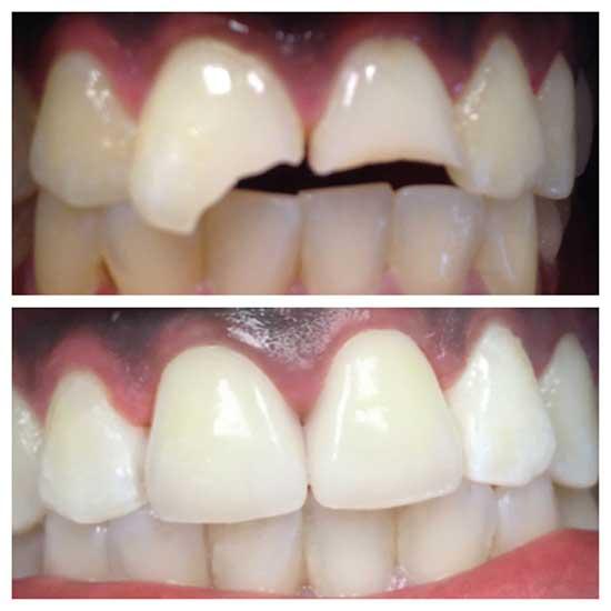 crowns being used for cosmetic smile makeover