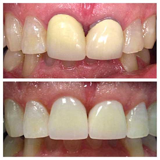 cosmetic dentist smile makeover with porcelain crowns