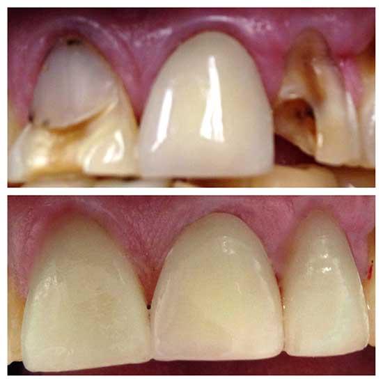 root canal treatment with new white crowns