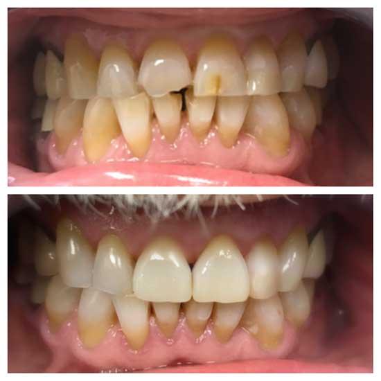 new smile after cosmetic dental work