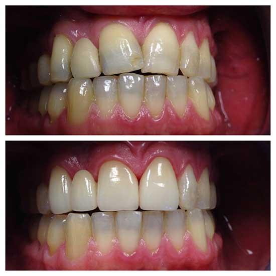 smile transform with whitening and bridge