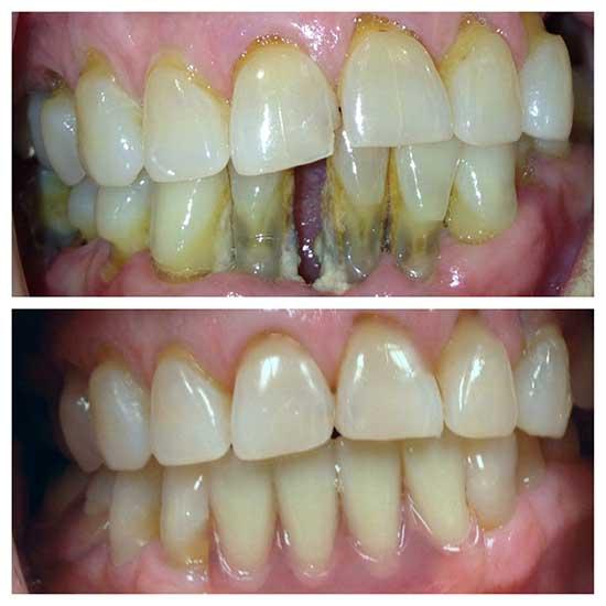 teeth deep cleaning extraction and flexible denture