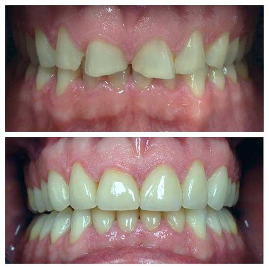 teeth veneers transforms patients smile