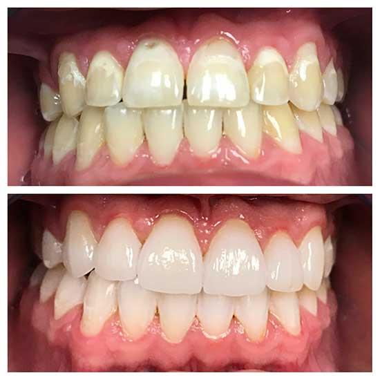 yellow stained teeth transformation by top cosmetic dentist