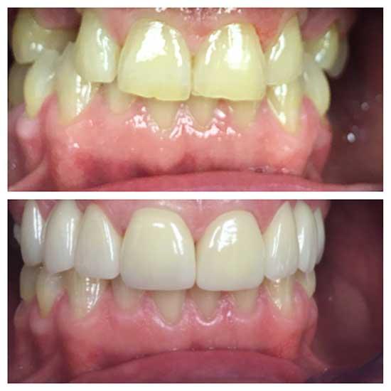 teeth whitened by Allen TX expert cosmetic dentist